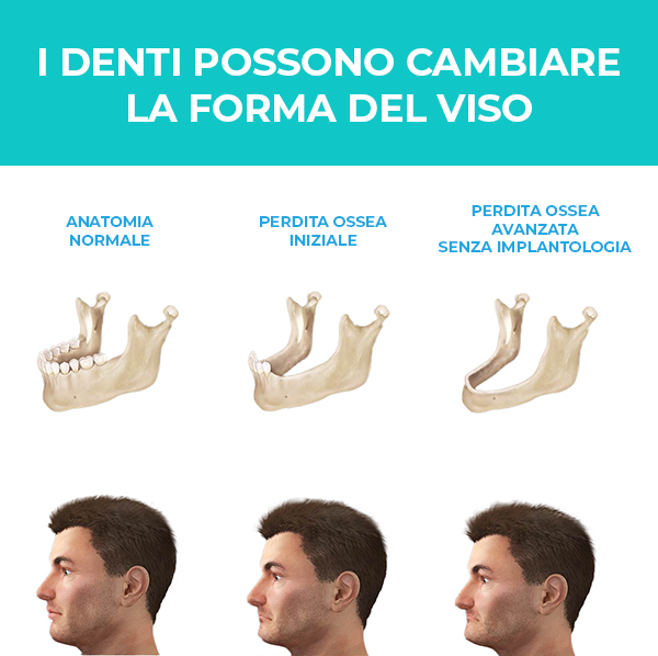 Implantologia Dentale